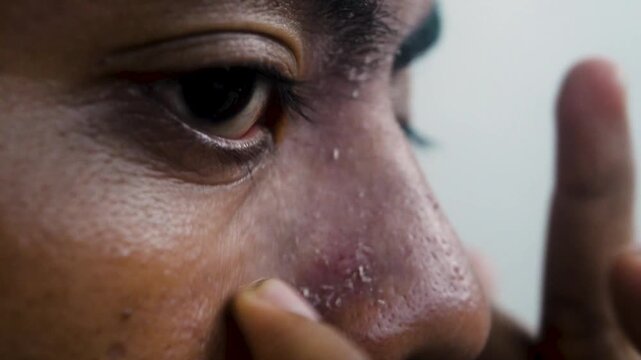 Close up man squeezing pimples on nose side with fingers showing skin pores and oily texture