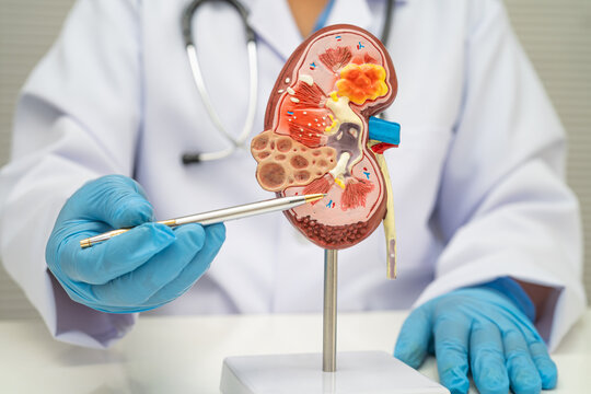 Chronic kidney disease, doctor with model for treatment urinary system, urology, Estimated glomerular filtration rate eGFR.