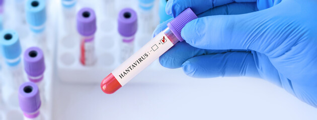 Doctor holding blood sample tube with positive hantavirus test in clinical laboratory, viral...