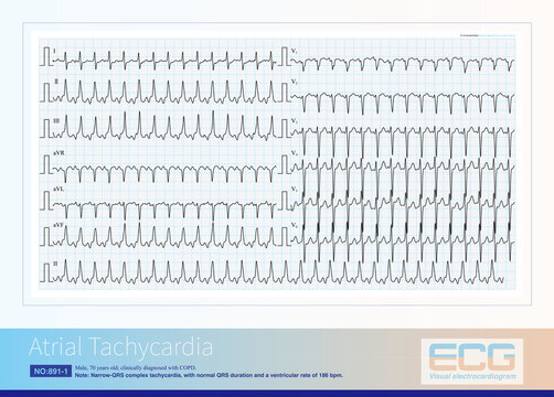 A 69-year-old male with a clinical diagnosis of COPD. During hospitalization, he experienced recurrent episodes of atrial tachycardia with a rapid ventricular rate.
