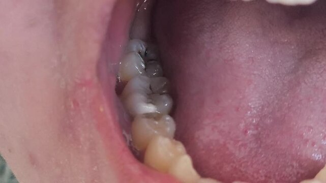 Close-up of caries on teeth, molars in a woman's mouth. Dental problems in adolescents. Dental treatment