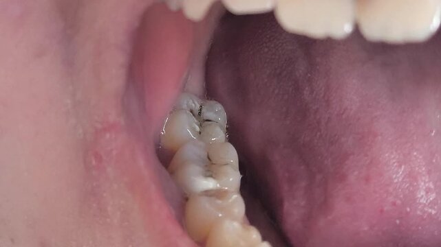 Close-up of caries on teeth, molars in a woman's mouth. Dental problems in adolescents. Dental treatment