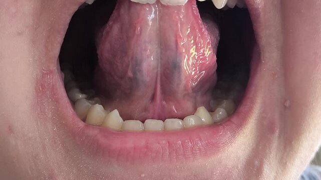 Tongue frenulum in the open mouth of a woman. Short tongue tie in adolescents, orthodontics.
