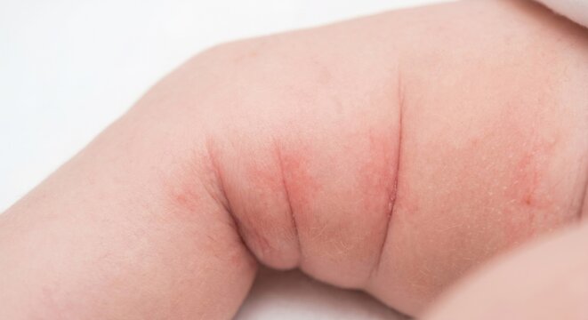 Redness and irritation in skin folds of a baby's leg