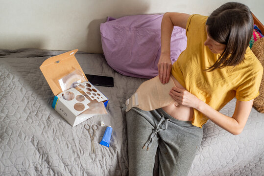 Young woman with a colostomy attaches a colostomy bag using paste.