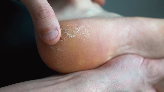 Close-up of a person's hands holding a foot and examining the dry, calloused, and cracked skin on the heel, a common dermatological condition requiring moisturizing care and treatment