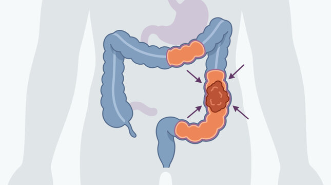Illustration of a human colon with a tumor or polyp in the large intestine