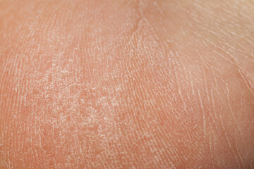 Naklejka premium Texture of dry skin as background, closeup