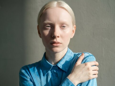 Close up of albino woman holding her shoulder, skin protection and dermatology awareness concept