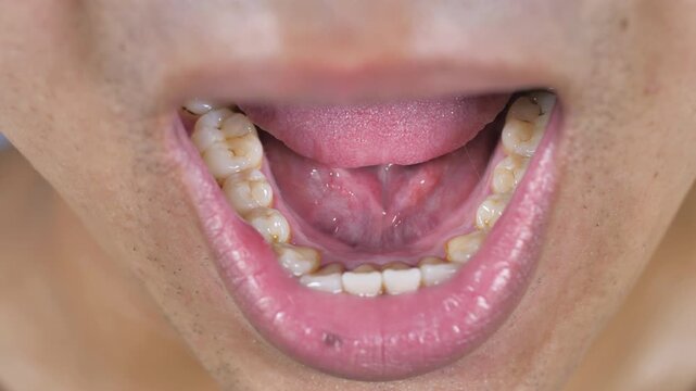 Yellow teeth, periodontitis, dental disease
