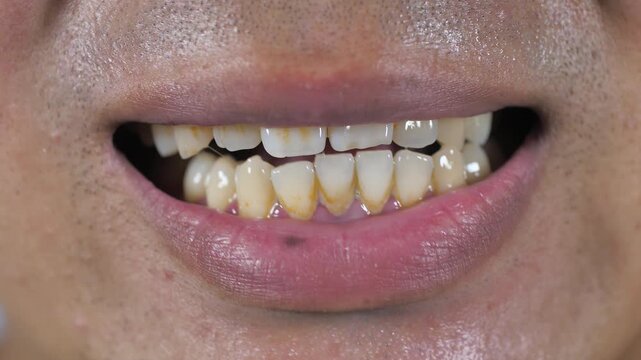 Yellow teeth, periodontitis, dental disease
