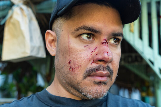 A young man with fresh facial lacerations especially on the upper bridge of the nose, and cheek scratches caused by a dog bite attack requiring urgent medical care and anti-rabies shots