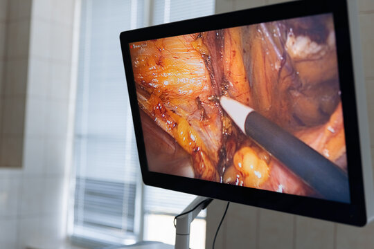 Laparoscopic surgical monitor and equipment in modern operating room
