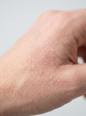 Fototapeta premium Close-Up of Dry Skin on Hand Showing Flakes and Texture Under Natural Light