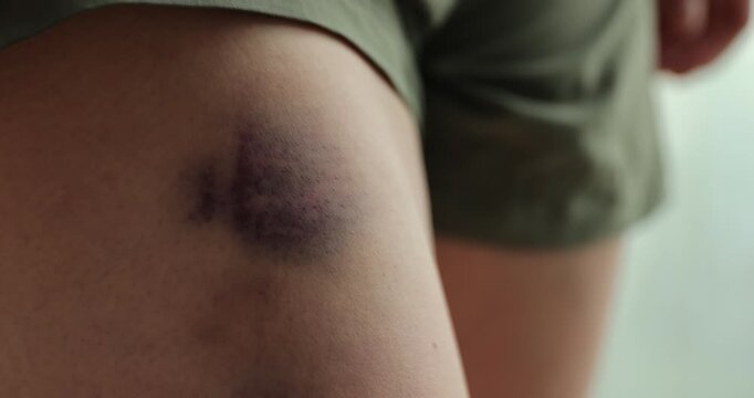 People show the bruised legs	