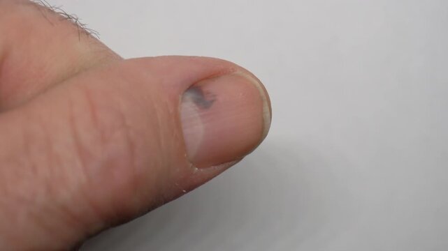 Close up of a subungual hematoma on a man's thumb. Bruising under fingernail.