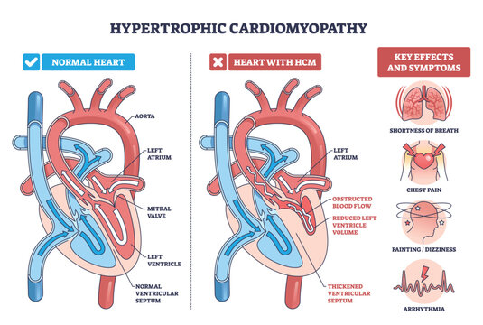 Hypertrophic cardiomyopathy diagram compares normal and HCM hearts, showing thickened ...