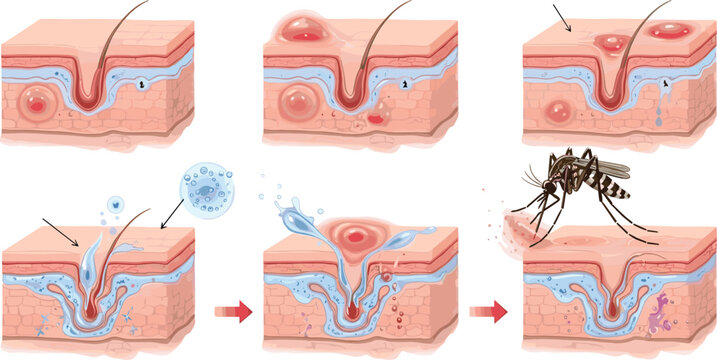 Mosquito bite skin reaction infographic diagram showing insect piercing human epidermis layer tissue vector science illustration