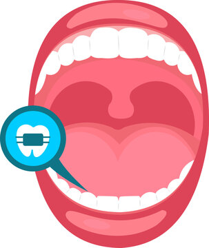 Mouth Infection Illustration