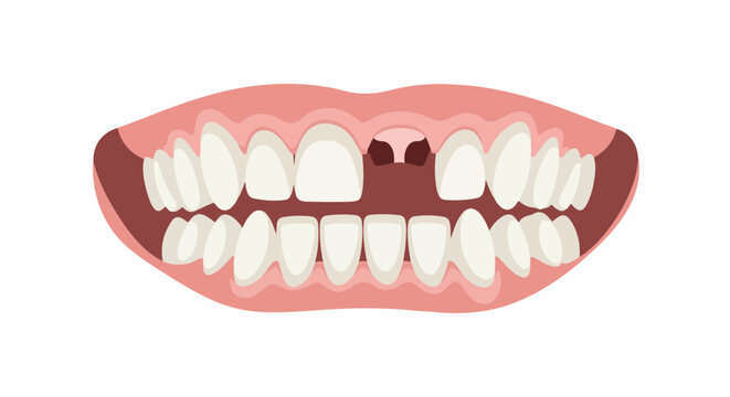A close-up illustration of a mouth showing teeth with one gap