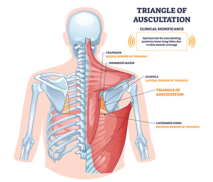Triangle of auscultation brief, back anatomy highlighting the small listening window bordered by trapezius, scapula, and latissimus dorsi for lung sounds. Diagram