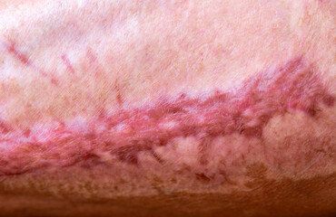 Fototapeta premium Large surgical scar on human thigh from skin graft donor site after severe infection treatment. Medical clinical image showing healed tissue, skin texture, and post-operative recovery process.
