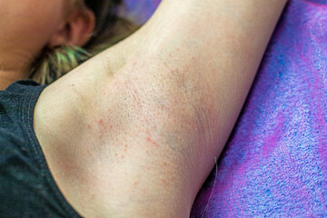 Fototapeta premium Armpit irritation from razor hair removal. Hygiene in adolescents.