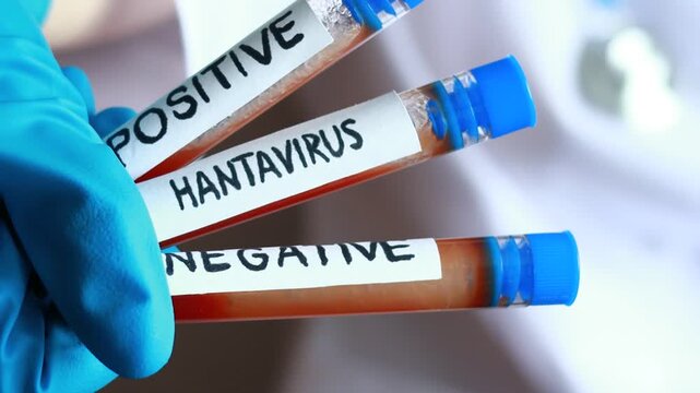 Lab technician holds test tubes showing hantavirus results in a medical setting.