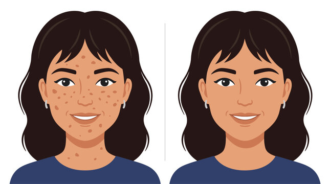 A comparative illustration of a woman with significant acne breakouts on her face next to a version of herself with a completely smooth and clear skin complexion.