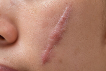 Fototapeta premium Macro Close Up of Raised Facial Scar and Healed Skin Tissue