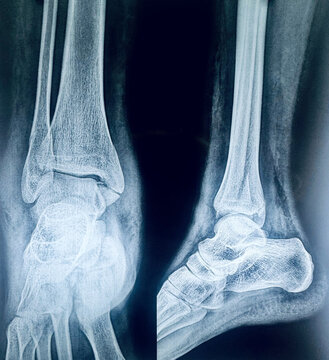 AP and lateral radiograph views displaying a bimalleolar ankle fracture of the tibia and fibula.