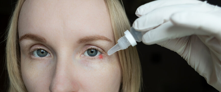 Close-up of a woman applying medical drops to treat a red eye stye or chalazion on the lower eyelid. Healthcare, ophthalmology and infection treatment concept.