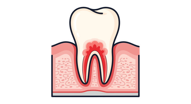 Tooth with inflamed pulp and root.