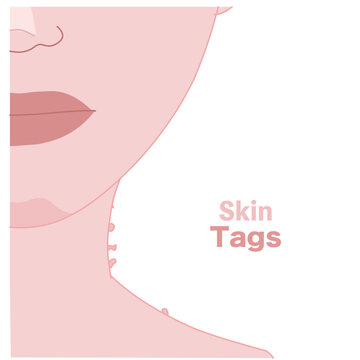 Skin tags are soft, tiny growths that often appear on the neck, underarms, or eyelids.. on the woman face. Illustration vector	