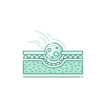 Acne formation cross-section, skin pore blockage, dermatological illustration