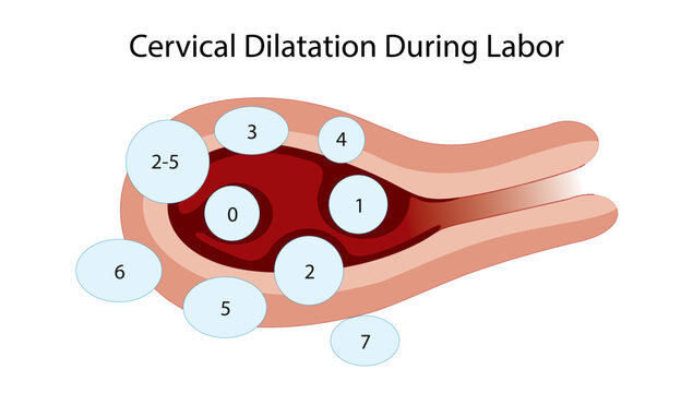 Cervical Dilatation During Labor
Obstetric illustration showing fetal station levels and cervical dilatation during labor progression in childbirth.