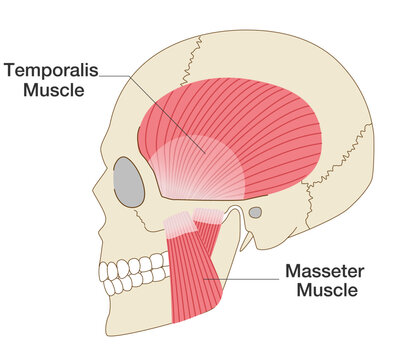 Anatomical illustration of the temporalis and masseter muscles with a skull viewed from the side (muscles involved in chewing force)