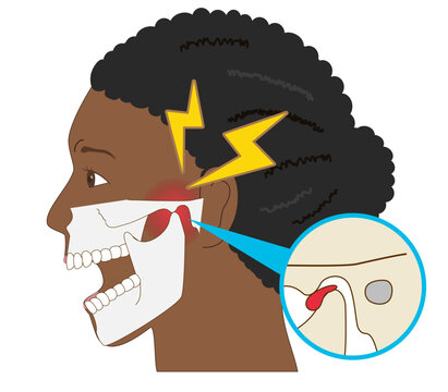 Anatomical illustration of a woman&rsquo;s profile suffering from jaw pain and temporomandibular disorder