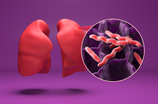 Mycobacterium tuberculosis in the lung - isometric view 3d illustration