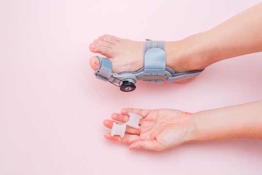 View on hallux valgus orthopedic medical thumb brace on female foot and silicone finger separator