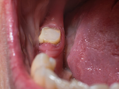 Prepared mandibular second molar for a 3-unit PFM bridge