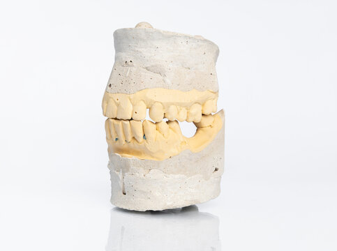 Laboratory dental stone model for orthopedic treatment