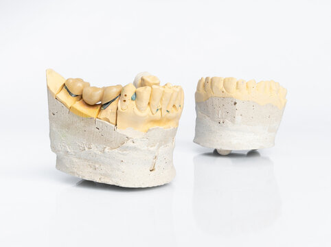 Dental stone models with a 3-unit PFM bridge on white