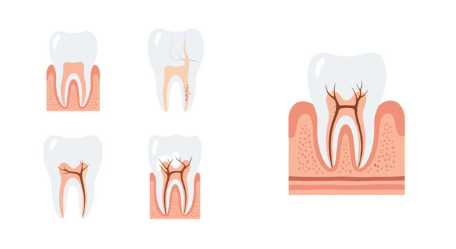 Stages of dental tooth decay and root canal infection diagram