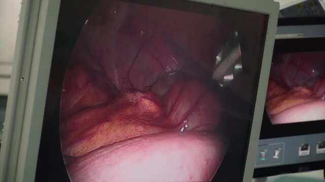 Laparoscopic cholecystectomy instrument in video on screen. The surgeon's doing laparoscopic gastric sleeve surgery
