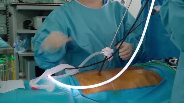 Laparoscopic cholecystectomy instrument. The surgeon's doing laparoscopic gastric sleeve surgery