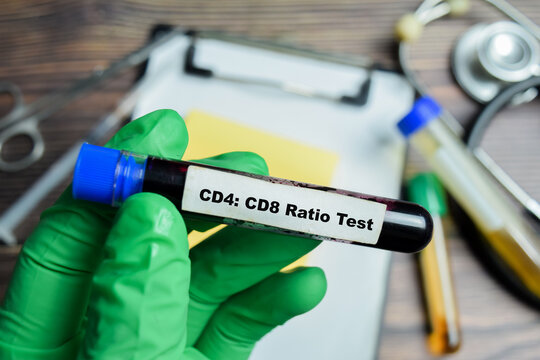 CD4 and CD8 ratio Test with blood sample in green gloved hands.