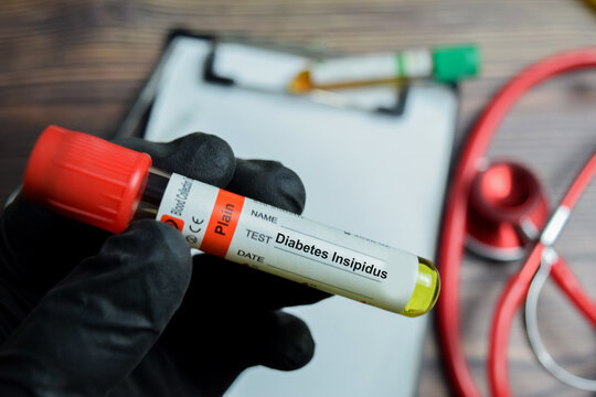 Diabetes insipidus Test with blood sample in black gloved hands. Caused by ADH or Arginine Vasopressin