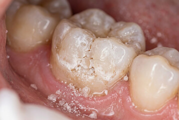 Obraz premium Tooth Crumbling Disintegrating Inside Mouth Extreme Macro Close-Up