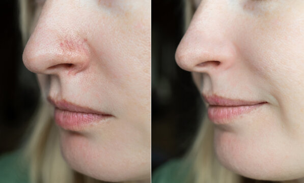 Before and after laser couperose removal on nose. Result of IPL therapy for facial vascular redness, capillaries coagulation and skin rejuvenation.